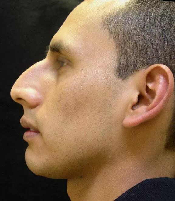 Ментопластика дистальный прикус. Выступающий нос. Выступающий нос. Нос с небольшой горбинкой. Маленький подбородок.