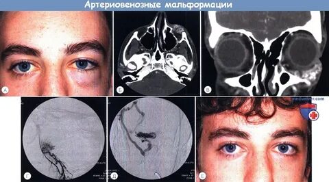 Лимфома орбиты глаза