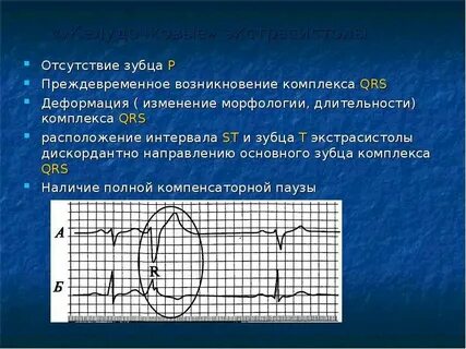 Дискордантность в экг