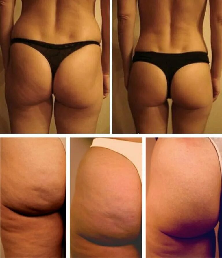 До и после антицеллюлитного массажа. Лпж галифе. Антицеллюлитный массаж. Эффект после антицеллюлитного массажа. Вакуумный массаж до и после.