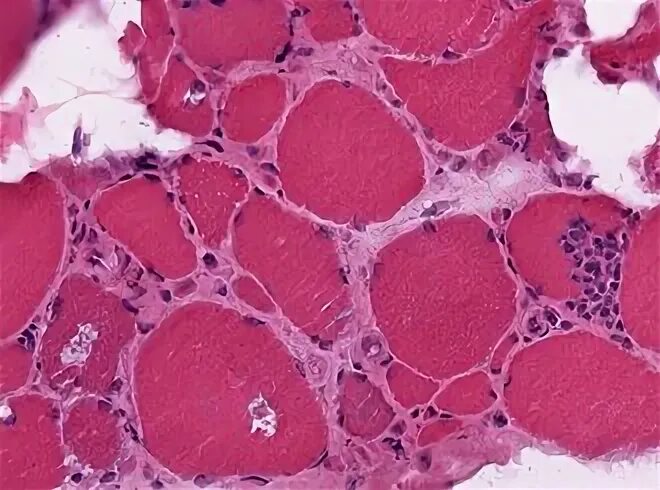 Myositis латынь
