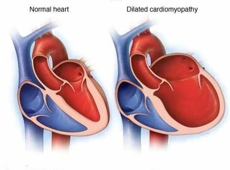 Дилатация правых отделов. Дилатационная гипертрофия. Концентрическая кардиомиопатия. Дилатационная кардиомиопатия сердца. Дилатационная кардиомегалия.