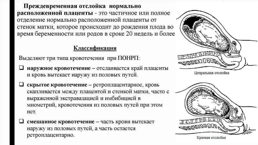 Беременность после первого полово. Ретроплацентарная отслойка плаценты. Отслойка нормально расположенной плаценты симптомы. Преждевременная отслойка плаценты симптомы. Осложнения при отслойке плаценты.