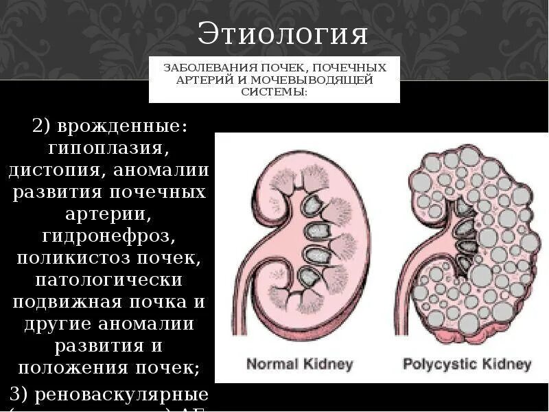 Признаки члс. Аномалии почек гипоплазия. Врожденный поликистоз почек. Поликистоз почки почки. Аномалия развития почек гидронефроз.