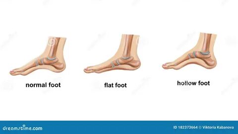 Flat footed