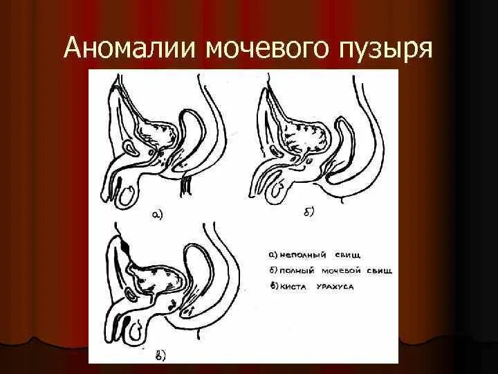 Аномалия мочевого. Аномалии мочевого пузыря. Аномалии мочевого пузыря классификация. Врожденные аномалии мочевого пузыря.