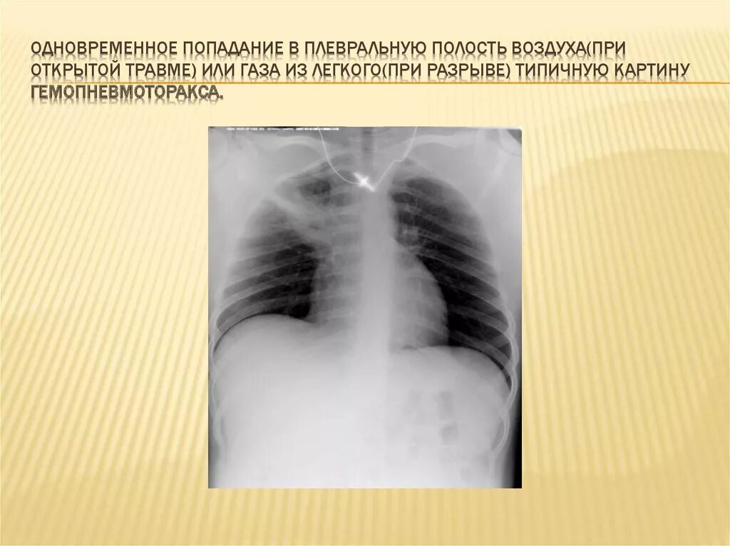 Попадания воздуха