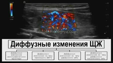 На фоне умеренных диффузных изменений. На фоне умеренных диффузных изменений