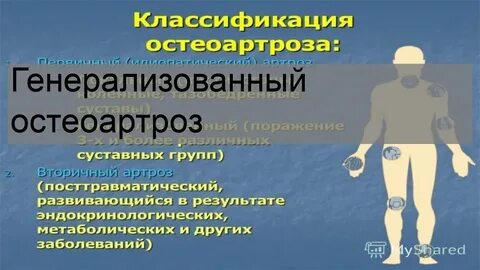 Генерализованный остеоартроз