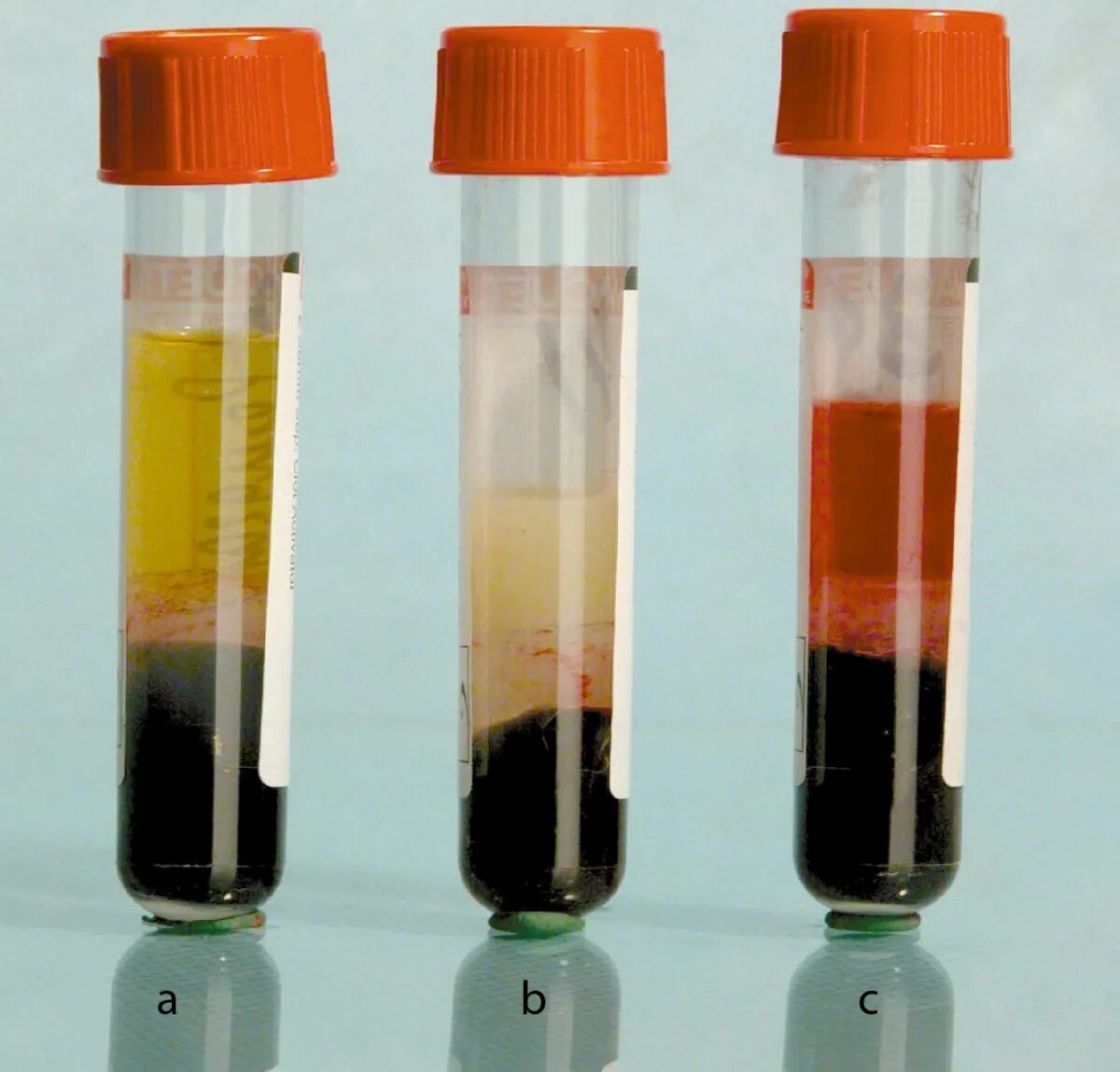 Проба сыворотки крови. Гемолиз хилез иктеричность. Сыворотка крови хилез гемолиз. Плазма крови после центрифугирования.