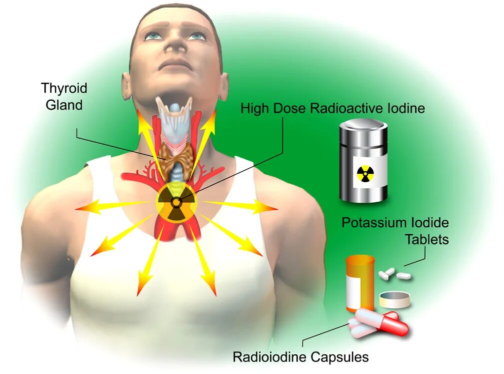 Поражение щитовидной железы радиоактивным йодом. Йод 131 щитовидная железа. Системная лучевая терапия радиоактивным йодом. Терапия радиоактивным 131i. Радиотерапия щитовидной