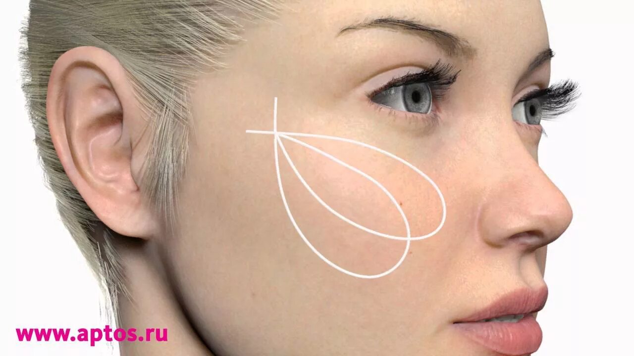 Aptos scan. Aptos light lift needle. аптос light lift needle 2g. aptos needle 2g soft. нити light lift needle 2g.