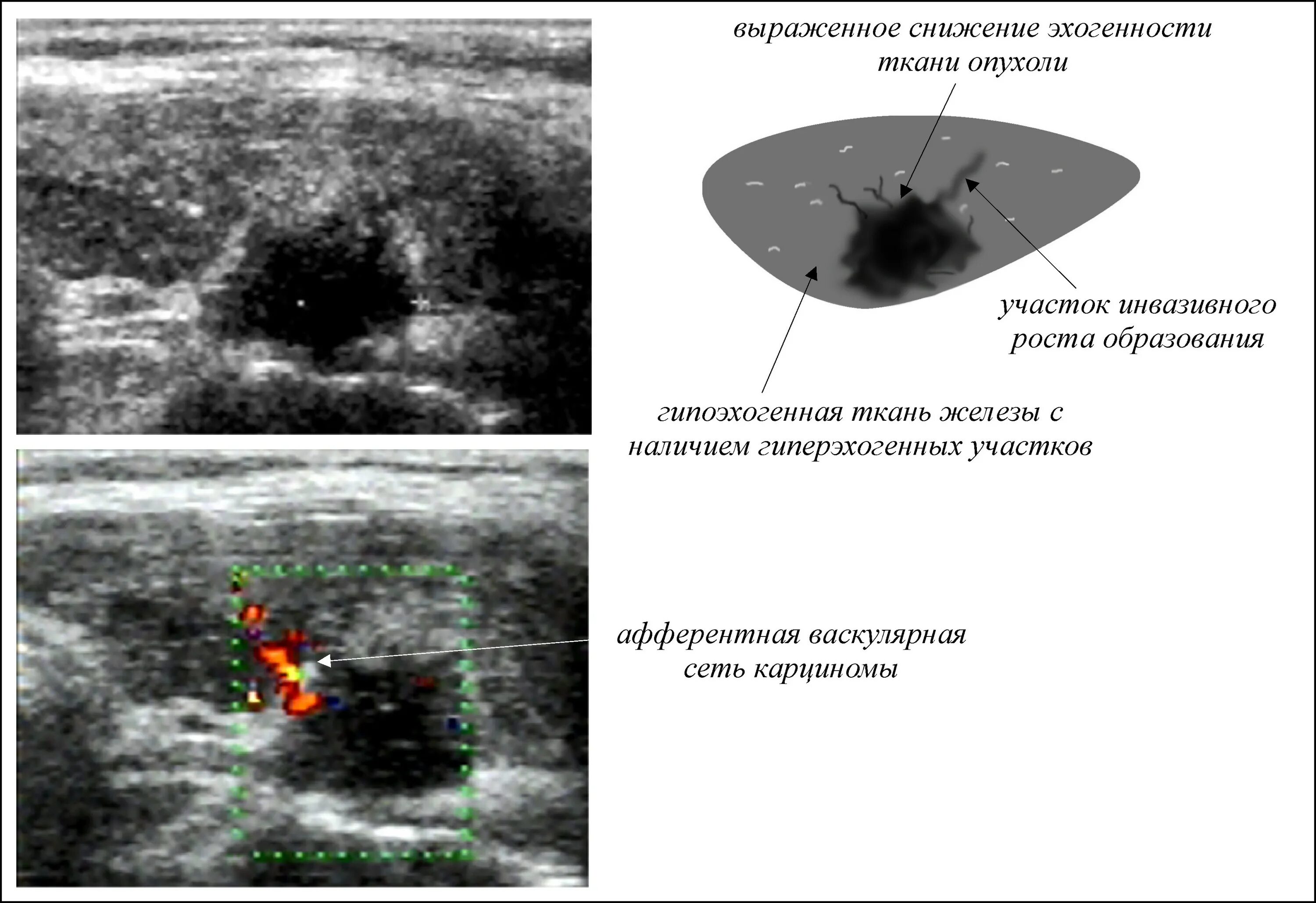 Образование без акустической тени. Сниженная эхогенность. Эхогенность на УЗИ. Ткань повышенной эхогенности молочной железы. Образования смешанной эхогенности.