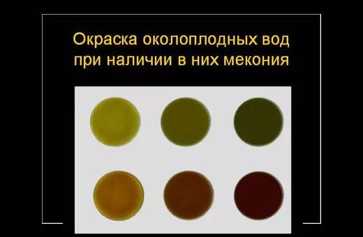 Цвет околоплодных вод. Как выглядят зеленые околоплодные воды. Цвет околоплодных вод норма. Коричневый цвет околоплодных вод свидетельствует о. Почему у беременной зеленые воды