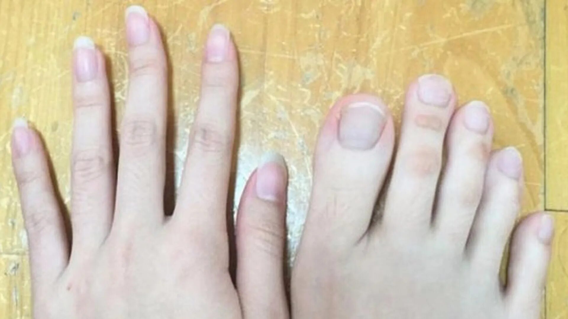 почему большие пальцы