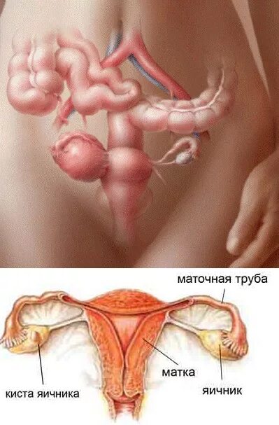 аднексит яичника узи снимок. матка и яичники расположение. киста яичиницы женщина. фото матки и яичников у женщин. склерокистоз яичников узи.
