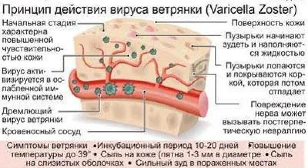 Ветряная оспа этапы высыпания. Сыпь при ветряная оспа. Стадии развития сыпи при ветряной оспе. Этапы развития ветрянрй сыпи.