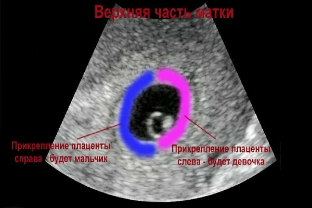 Пол ребенка на ранних сроках. На какой неделе можно определить пол ребенка. УЗИ пол ребенка на раннем сроке. Пол ребёнка на ранних сроках по УЗИ. На какой неделе можно узнать пол ребенка по УЗИ.