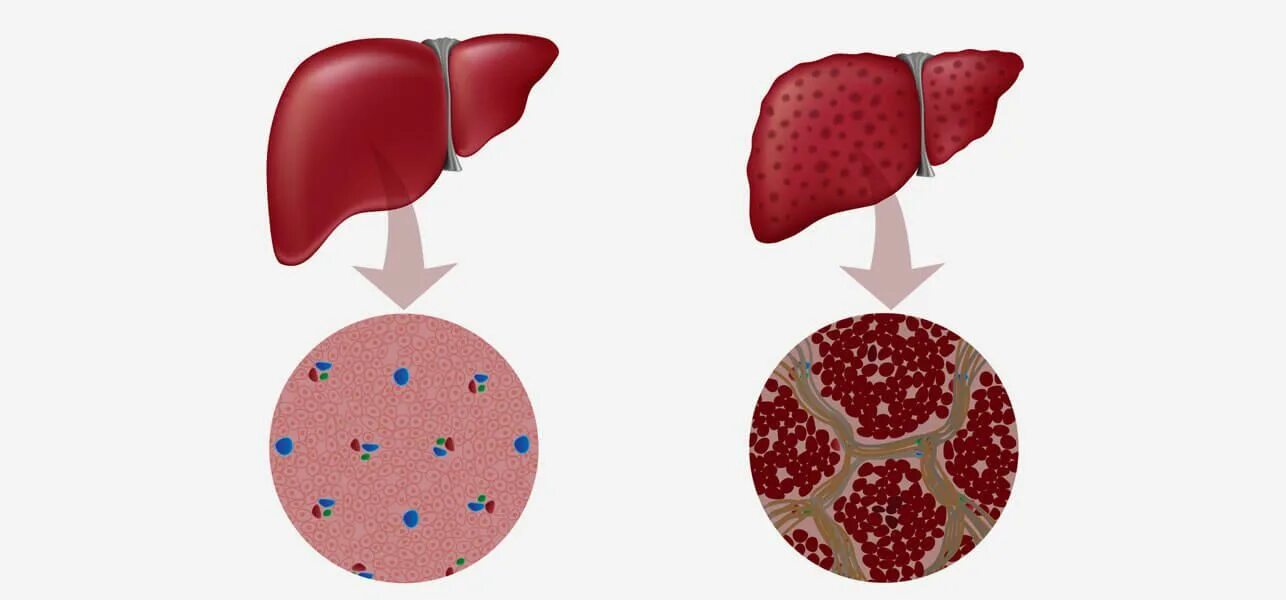 Клетки печени разрушаются. Цирроз печени картинки. Здоровая печень и цирроз. Церроз Печин.