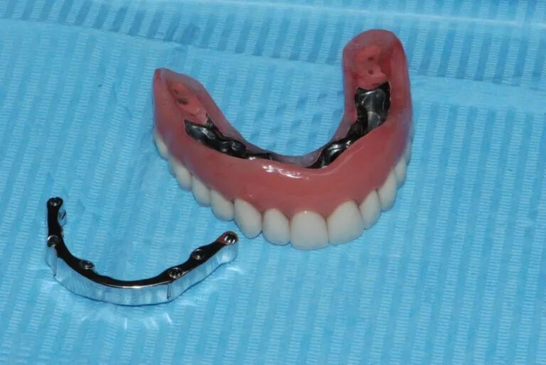 Съемный протез (6-14 зубов) термо Джет. Пластинчатый микропротез. Съёмный зубной протез на крючках.