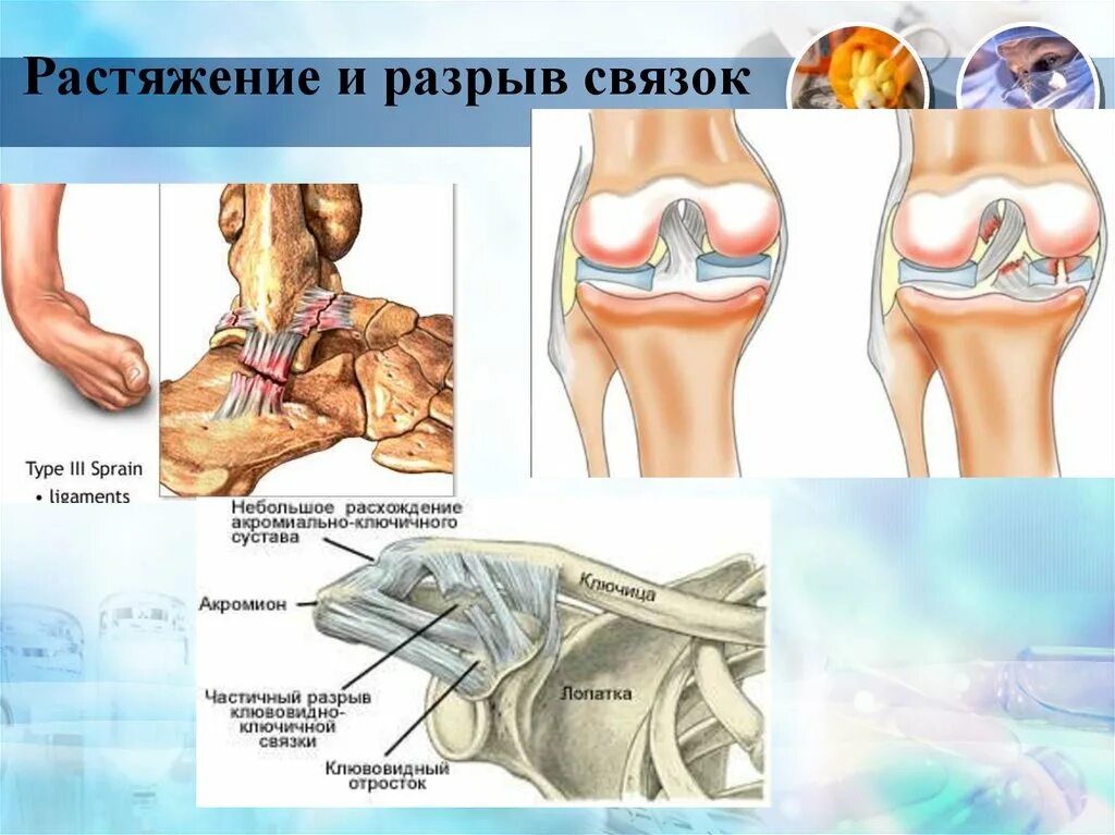 Показать разрыв. Растяжения, повреждения связок.. Растяжение и разрыв связок.