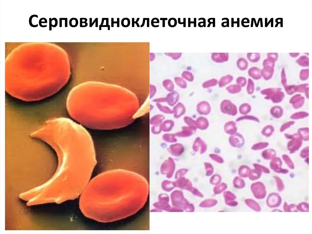 Анемия наследуется. Анемия наследуется