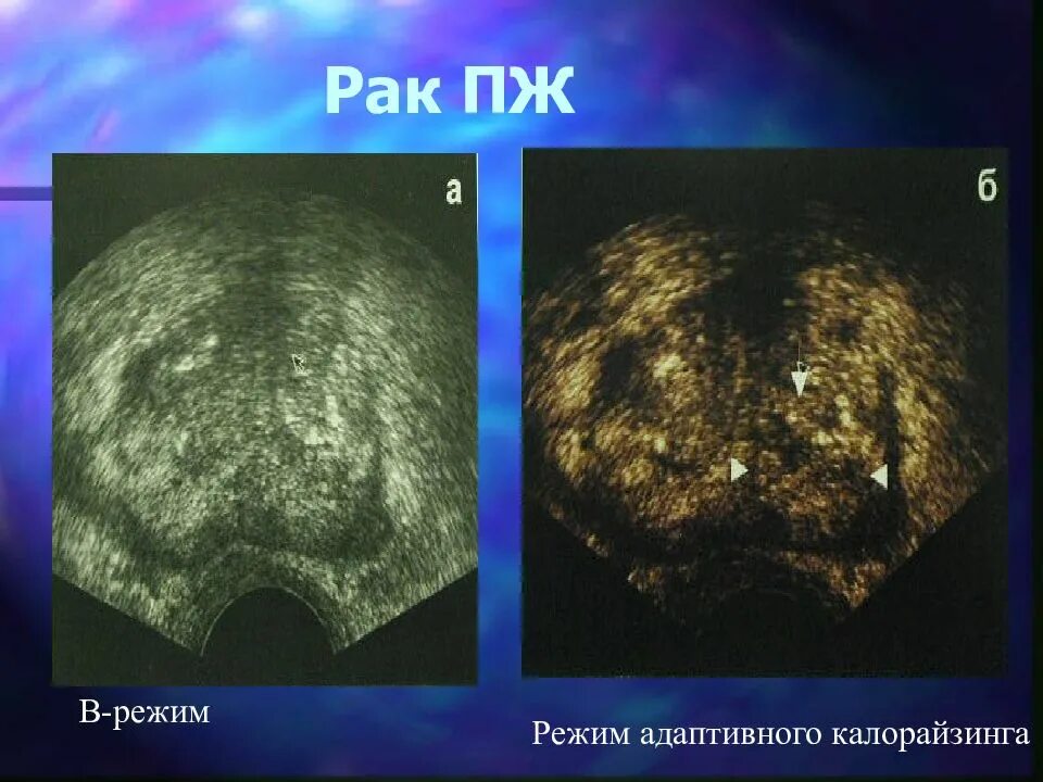 Дгпж узи. Ультразвуковая диагностика заболеваний предстательной железы. УЗИ доброкачественная гиперплазия предстательной железы. Аденома предстательной железы на УЗИ.