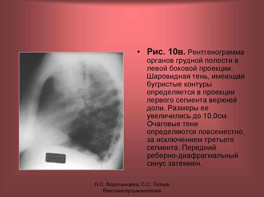 Тень в верхней доле. Рентгенограмма органов грудной полости. Рентгенограмма органов грудной полости в боковой проекции:. Доли левого легкого в боковой проекции. Округлые тени на рентгенограмме легких.