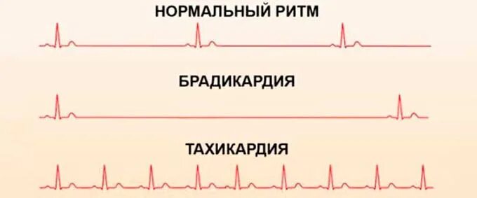 Аритмия при нормальном давлении и пульсе