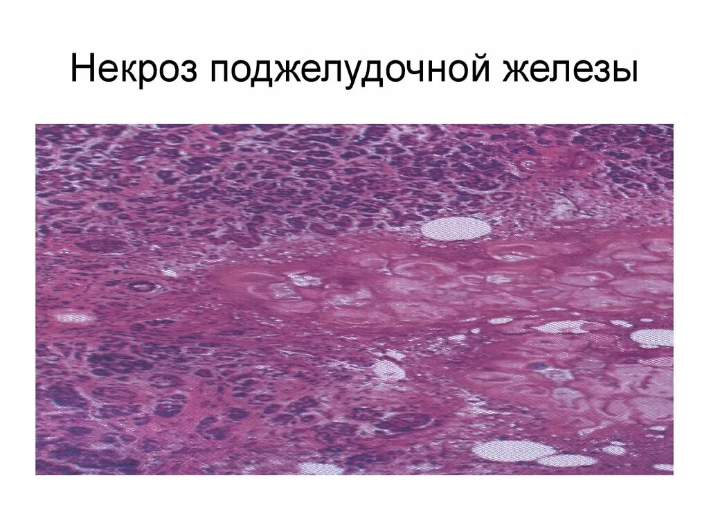 Что такое некроз поджелудочной железы у мужчин. Панкреонекроз стеатонекроз. Жировой панкреонекроз гистология. Геморрагический панкреонекроз патанатомия. Стеатонекроз поджелудочной железы гистология.