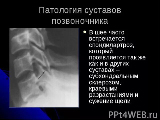 Склероз замыкательных пластинок позвоночника рентген. Склероз замыкательных пластинок тел позвонков поясничного отдела. Замыкательные пластинки тел позвонков на рентген. Замыкательные пластинки позвонков склерозированы.