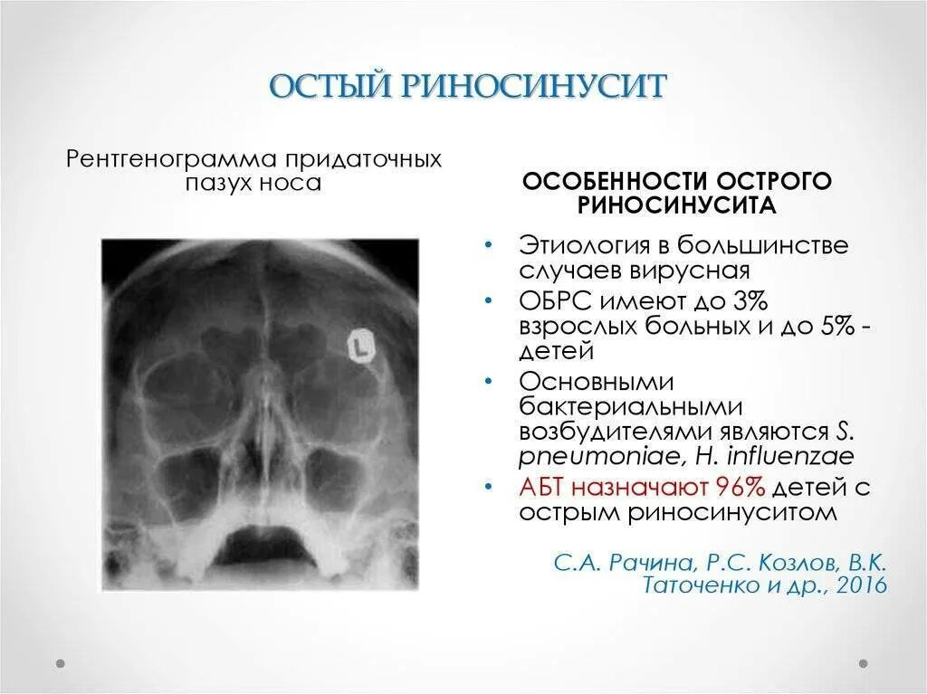 Риносинусит у ребенка симптомы. Поствирусный риносинусит. риносинусит предшествует развитию.