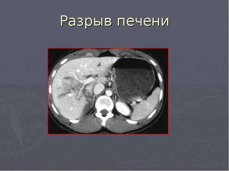 Разрыв 30. Подкапсульный разрыв печени кт. подкапсульный разрыв селезенки кт.