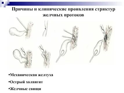 Желчные свищи