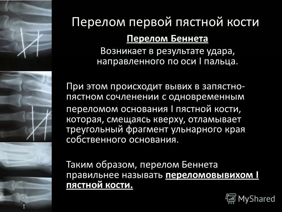 экспертиза переломов костей