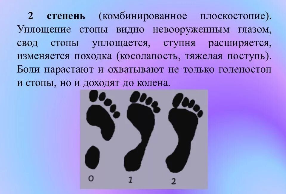 Продольное плоскостопие 2. Степень плоскостопия 2 степень. плоскостопие 2 степени уплощение стопы. вторая стадия продольного плоскостопия. поперечное плоскостопие ii степени.