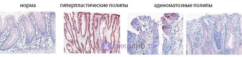 Микровезикулярный полип толстой кишки. Полип толстой кишки гистология. Гиперпластический полип толстой кишки гистология. Ворсинчатый полип гистология. Аденоматозные полипы гистология.