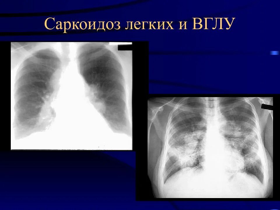 Саркоидоз внутригрудных лимфатических узлов рентген. Саркоидоз внутригрудных лимфоузлов рентген. Саркоидоз рентген грудной клетки. Медиастинально-легочный саркоидоз. Аденопатия