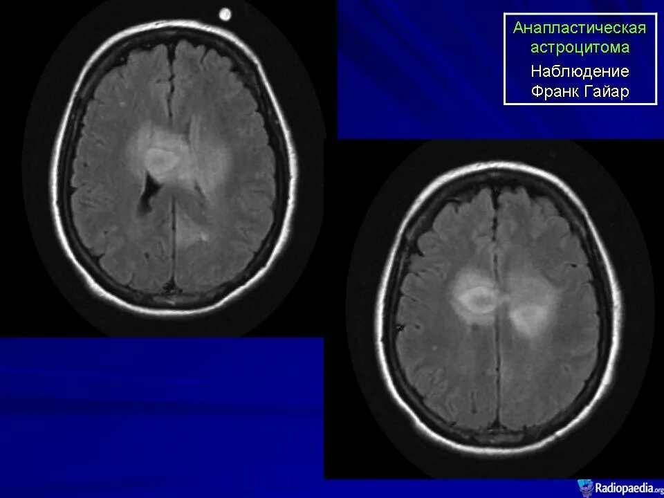 Анапластическая астроцитома головного мозга. Кистозная астроцитома кт. Диффузная астроцитома