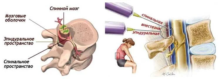 Эпидуральная спинная. Спинномозговая и эпидуральная анестезия. Эпидуральная анестезия и спинальная анестезия. Эпидуральная и спинальная анестезия разница. Отличие спинномозговой анестезии от эпидуральной.