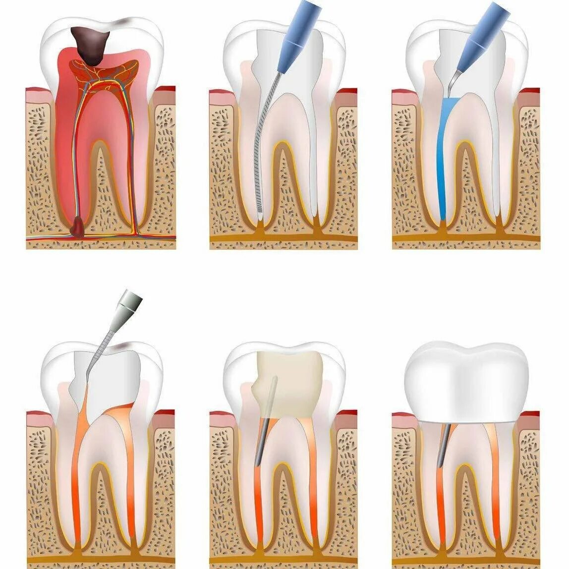 Сколько ходят с лекарством в зубе. Классификация кариес пульпит периодонтит. Пломбирование каналов горячей гуттаперчей. Периодонтит 3 корневого зуба.