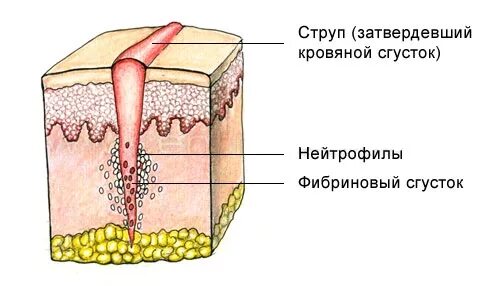 Стадии заживления после. Заживление РАН грануляционная ткань.