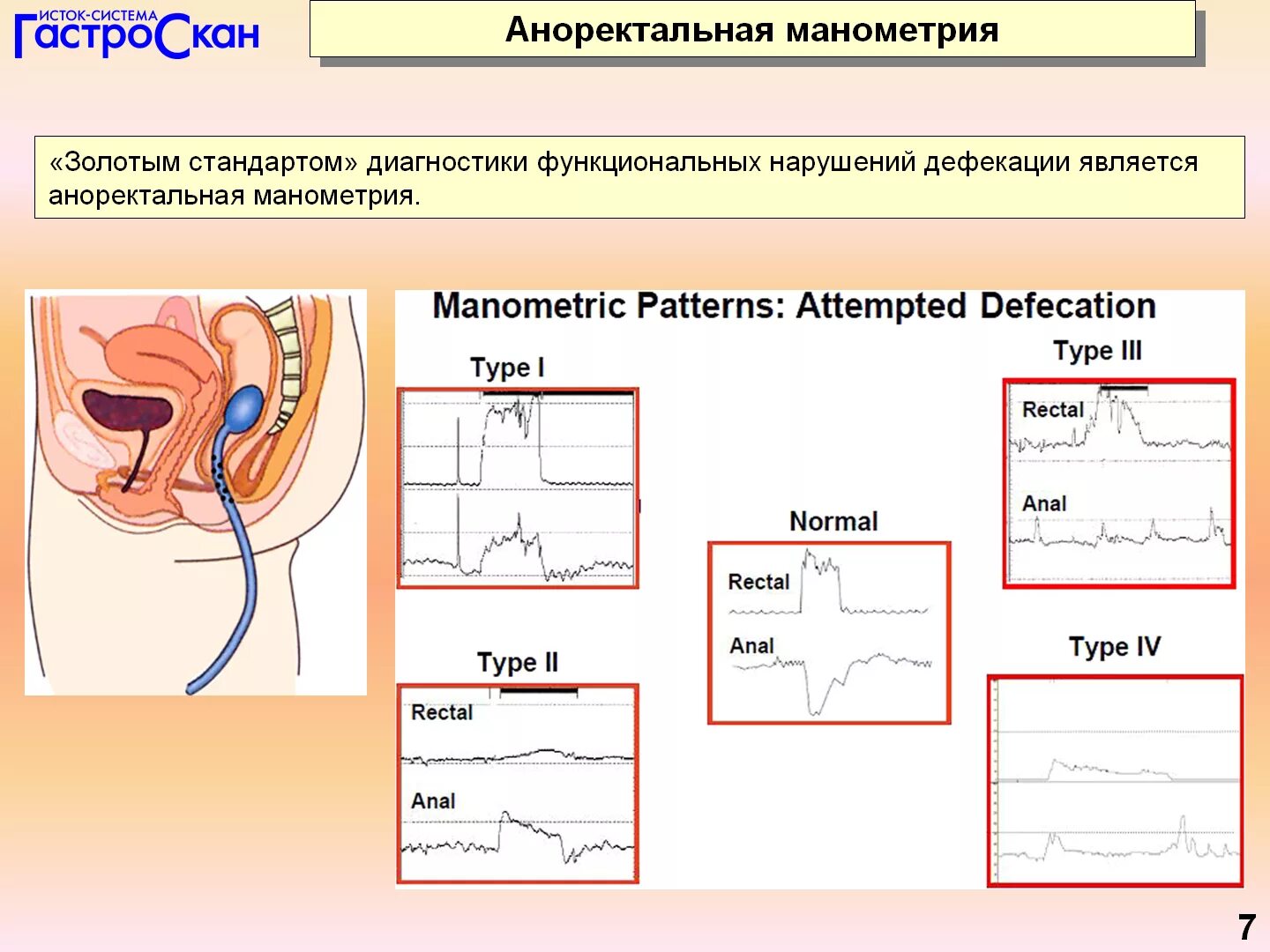 Тест ректально. Аноректальная манометрия. Ректальная манометрия. Манометрия сфинктера прямой кишки. Эзофагеальная манометрия.