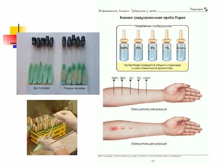 Проба пирке. Что такое реакция манту и проба Пирке. Кожная градуированная проба Пирке. Проба манту ,Коха,Пирке. Аллергопробы положительная реакция.