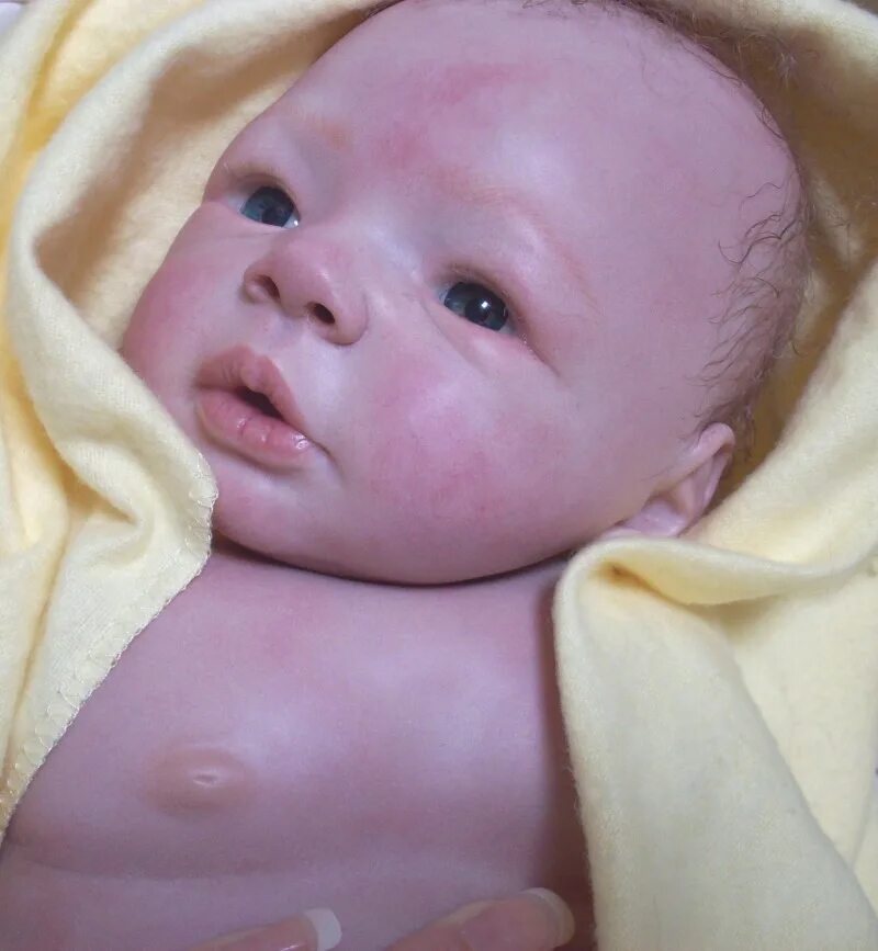 У грудничка синеет подбородок. Цианоз кожи у новорожденных. Синюшность носогубного треугольника. Цвет носогубный треугольник. Цианотичные кожные покровы новорожденный.