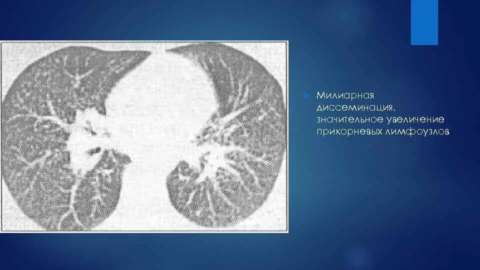 Дерева в почках в легких кт. Диссеминированный туберкулез на кт. Диссеминированный туберкулез легких на кт. Диссеминированный милиарный туберкулез легких кт. Милиарный туберкулез легких кт.