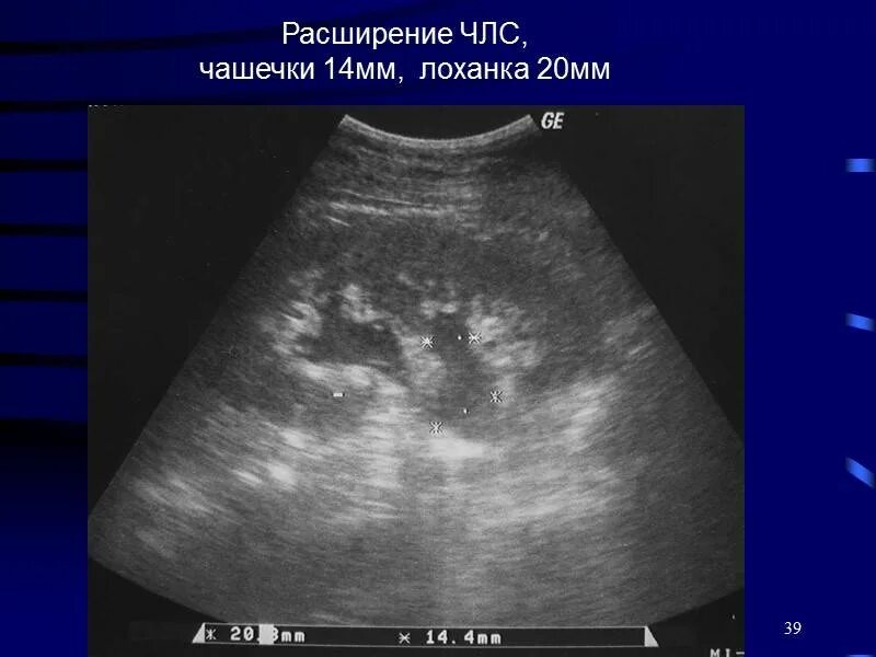 Расширение члс левой почки. Расширение лоханки почки на узи. чашечно-лоханочная система почки на узи. расширение почечной лоханки на узи. расширение чашечно-лоханочной системы узи.