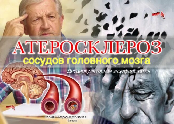 Головного мозга атеросклероз народное средство. Церебральный атеросклероз. Атеросклероз церебральных сосудов. Атеросклероз головного мозга. Церебральный атеросклероз степени.