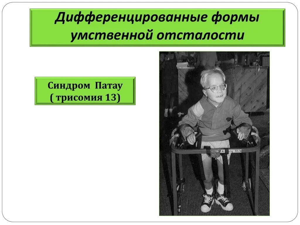 Умеренная легкая умственная отсталость. Синдром Патау (трисомия по 13-й хромосоме). Синдром Патау (трисомия в 13-Ой хромосоме);. Умственная отсталость. Синдром умственной отсталости.