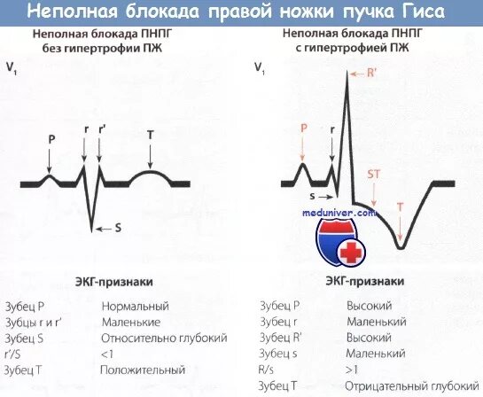 Сердце неполная блокада правой ножки гиса. Признаки неполной блокады правой ножки пучка Гиса на ЭКГ. Неполная блокада правой ножки пучка Гиса на ЭКГ. Неполная блокада ножек пучка Гиса на ЭКГ. Блокада правого пучка Гиса на ЭКГ.